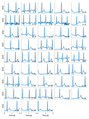 **ECG signals throughout the testing:** Short 2-second samples of ECG signals obtained through the 7 days of testing. _Defintion: Hr - hour_