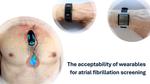 The acceptability of wearables for atrial fibrillation screening: Interim analysis of the SAFER Wearables Study