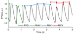 Toward a robust estimation of respiratory rate from pulse oximeters
