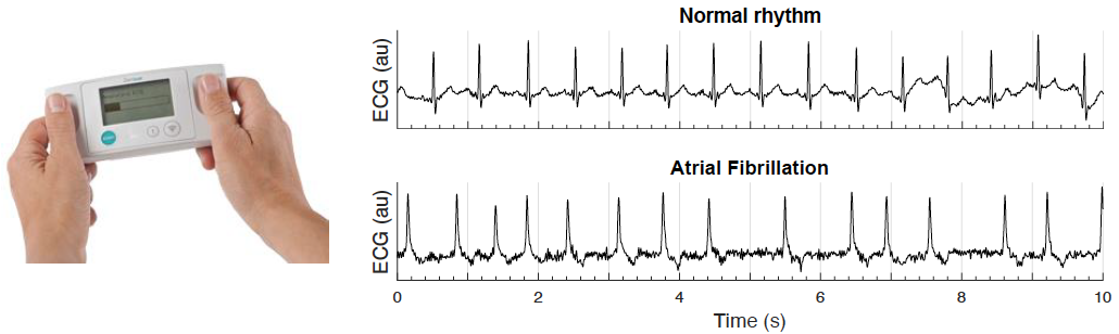 **Zenicor-EKG device and recorded ECGs**: A handheld device for recording single-lead ECGs. _Source: [Pandiaraja M. _et al._](https://doi.org/10.3390/ecsa-7-08195), [CC BY 4.0](https://creativecommons.org/licenses/by/4.0/)_
